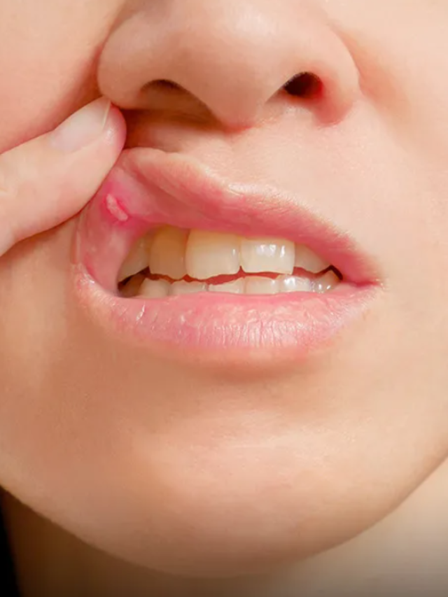 Navigating Mouth Ulcers: A Dietary Guide for Relief